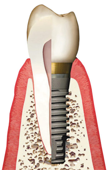 dental implant albuquerque